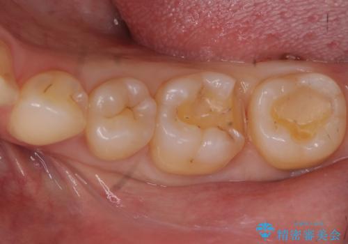 治療途中で放置した奥歯 セラミックインレーでの修復の治療中