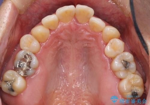 インプラント治療を併用した全顎歯周病治療の治療前