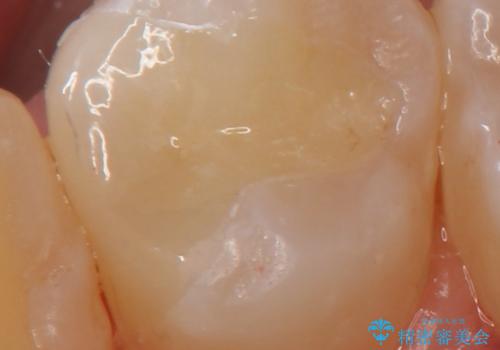 奥歯の虫歯 セラミックインレーによる治療の症例 治療後