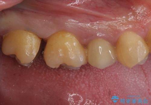 放置していた虫歯 セラミックインレーによる治療の治療中