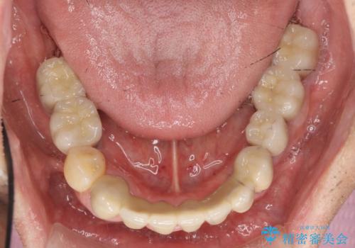 インプラント治療を併用した全顎歯周病治療の治療後
