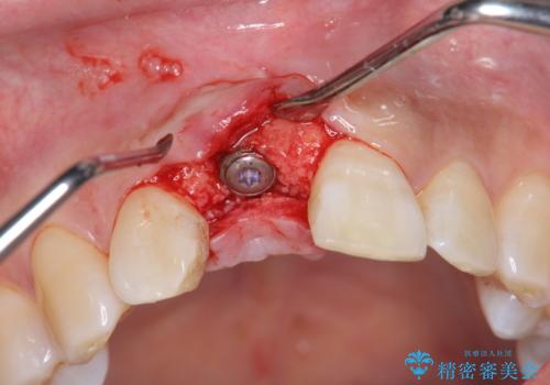 骨造成を伴う前歯のインプラント治療の治療中
