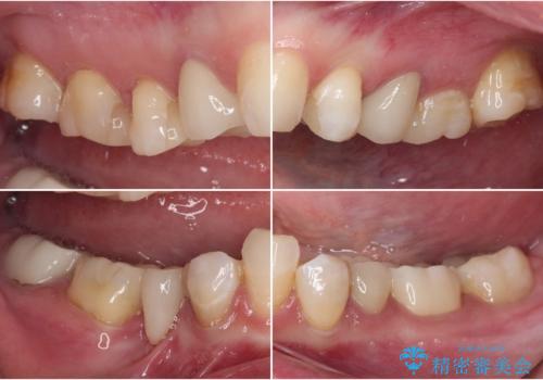 金属の見えてしまったクラウン セラミッククラウンで自然にの治療後