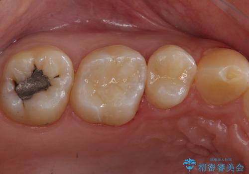 たまにしみる奥歯 セラミックインレーでの修復の治療後