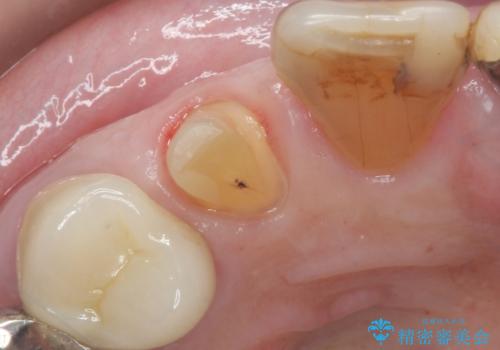 大きい虫歯で欠けた前歯 セラミッククラウンで治療の治療中