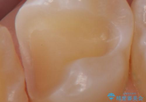 奥歯の虫歯 セラミックインレーによる治療の治療中