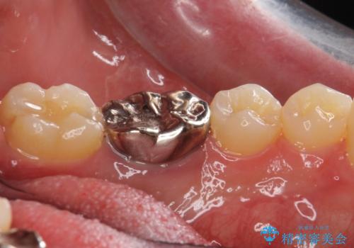 銀歯のやり替え セラミックで白い歯にの治療前