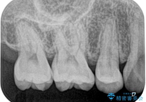 矯正終了し、銀歯が見えるため治してほしい。セラミック治療の治療後