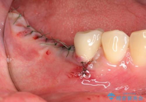 臼歯部インプラント治療の治療中