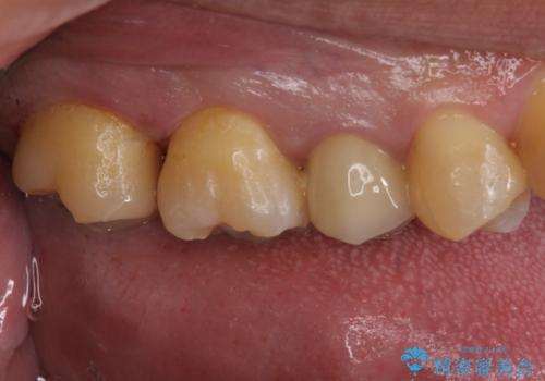 放置していた虫歯 セラミックインレーによる治療の治療後