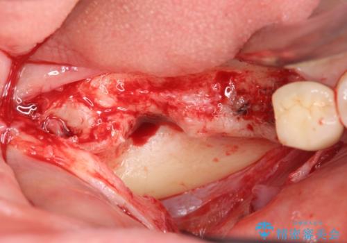 臼歯部インプラント治療の治療中