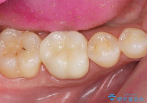 放置してしまった虫歯の治療の治療後