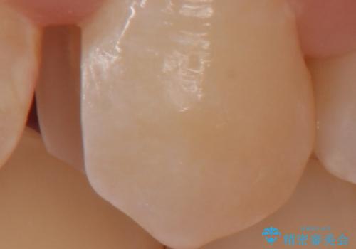 奥歯の虫歯 セラミックインレーによる治療の治療中