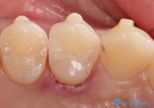 【セラミックインレー】歯と歯の間の虫歯治療の症例 治療後