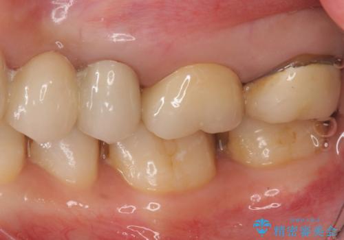 時々しみる奥歯 適合の悪いインレーからクラウンへのやり替えの治療後