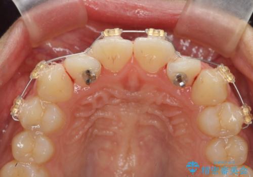 ワイヤー部分矯正を併用して治療期間を短縮 マウスピース矯正治療の治療前
