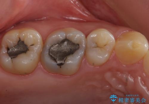 たまにしみる奥歯 セラミックインレーでの修復の治療前