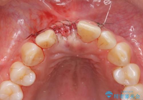 骨造成を伴う前歯のインプラント治療の治療中