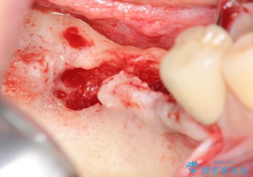 臼歯部インプラント治療の治療中