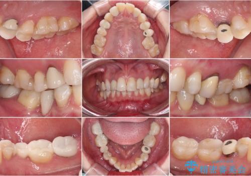 金属の見えてしまったクラウン セラミッククラウンで自然にの治療前