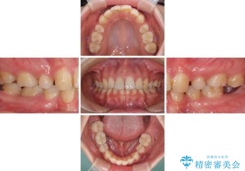 部分矯正を併用した奥歯のインプラント治療の治療前