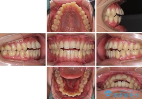 隙間が空いて突出した前歯を治したい ワイヤー装置による抜歯矯正の治療前