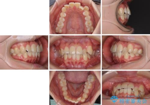 【モニター】八重歯と前歯のクロスバイト ワイヤーを併用しインビザラインで矯正治療の治療前