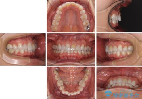 矯正治療の後戻り インビザライン・ライトでの再矯正の治療前