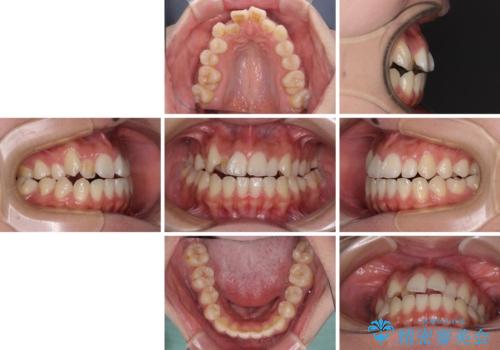 急速拡大装置 狭い上顎骨を拡大してワイヤー装置で短期間治療の治療前