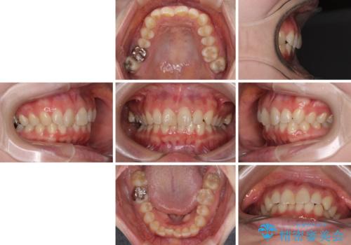 転勤予定がある インビザラインによる矯正治療の治療前