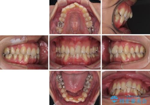 ワイヤー装置をインビザラインへ 装置変更での矯正治療の治療前