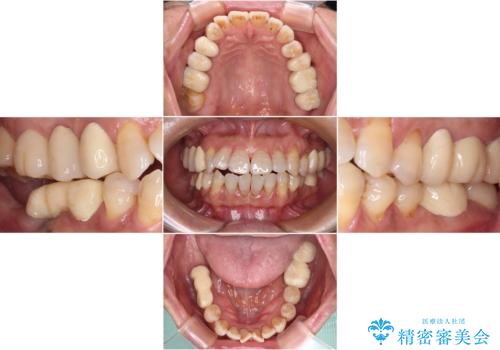 治療後に歯茎から出血 インプラントとオールセラミッククラウンの補綴治療の治療前