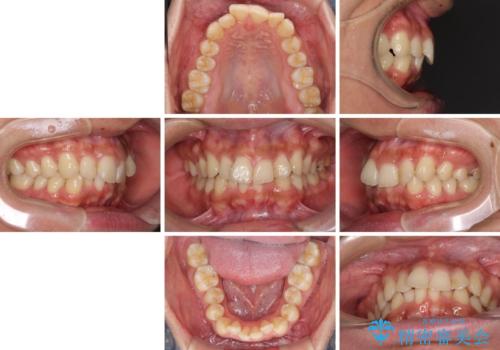 前歯のデコボコをスッキリ改善　インビザライン矯正の治療前