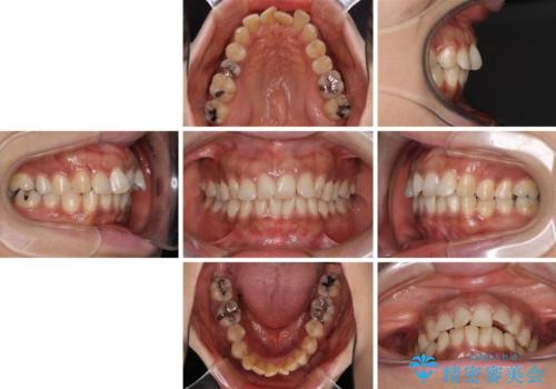 インビザラインでのんびりと矯正治療 の治療前