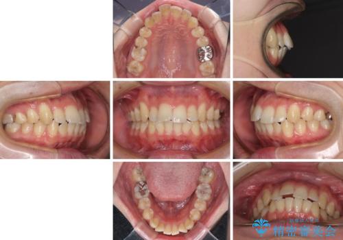 前歯のデコボコを治したい ワイヤー装置でお手軽に矯正治療の治療前
