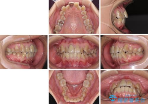 八重歯とクロスバイト 目立たないワイヤー装置での抜歯矯正の治療前