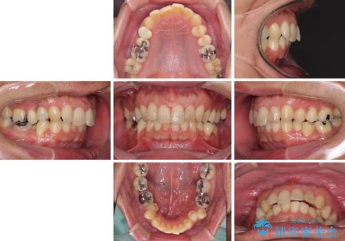 外側に飛び出した歯　インビザラインによる矯正治療の治療前