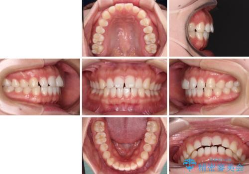 すきっ歯とオープンバイト　インビザライン・ライトで改善の治療前