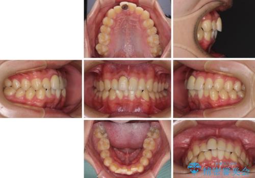前歯のデコボコを治したい インビザライン矯正治療の治療前