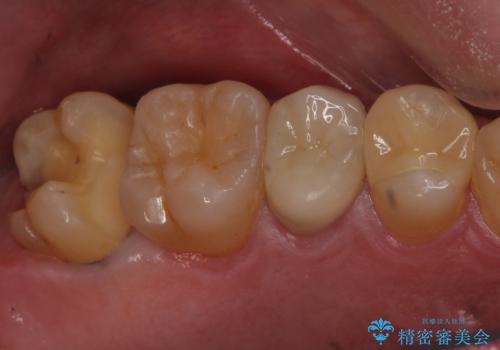 放置していた虫歯 セラミックインレーによる治療の治療中