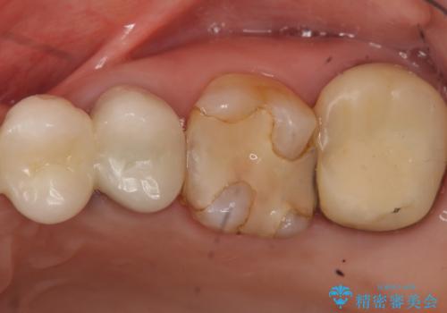 時々しみる奥歯 適合の悪いインレーからクラウンへのやり替えの治療前