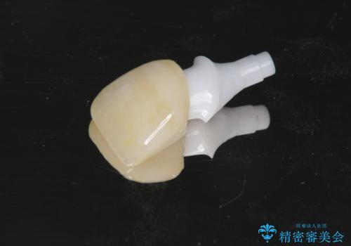 骨造成を伴う前歯のインプラント治療