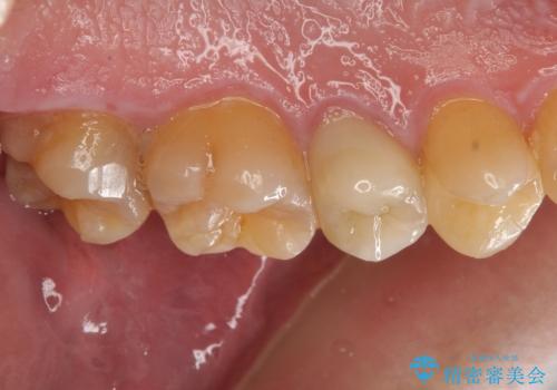 放置していた虫歯 セラミックインレーによる治療の治療前