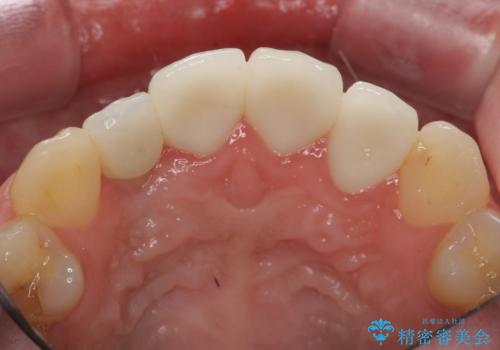 前歯の虫歯 オールセラミック治療の治療後