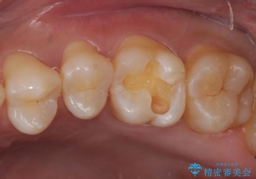 奥歯に隠れた虫歯　セラミックインレーでの修復の治療中