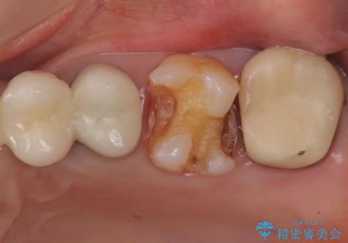 時々しみる奥歯 適合の悪いインレーからクラウンへのやり替えの治療中