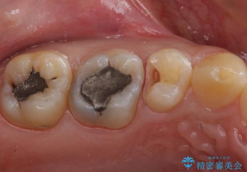 たまにしみる奥歯 セラミックインレーでの修復の治療中