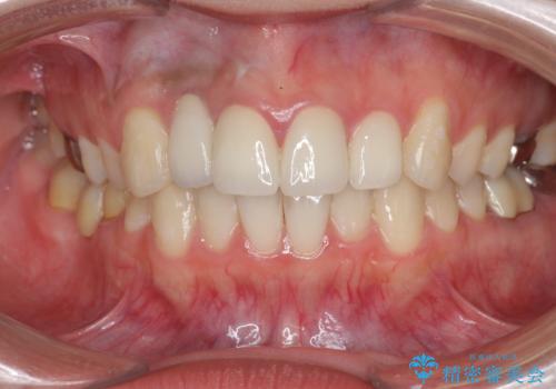 前歯の虫歯 オールセラミック治療の治療後