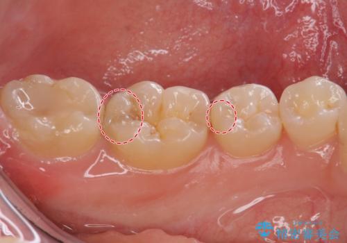 隠れているむし歯 セラミックインレーによる治療の治療前