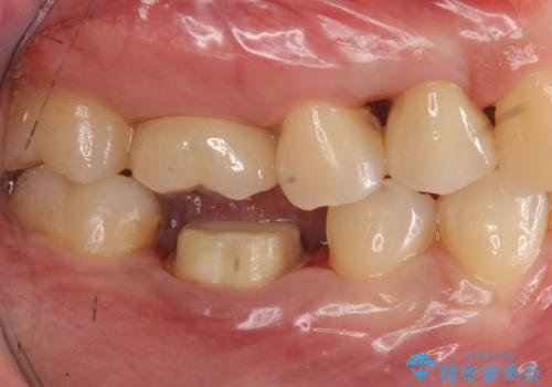 銀歯のやり替え セラミックで白い歯にの治療中